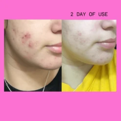 Pimple Paste Overnight Drying Paste -Beauty Essence Shop NEWBAFORSHOPIFY