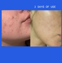 Pimple Paste Overnight Drying Paste -Beauty Essence Shop NEWBAFORSHOPIFY1