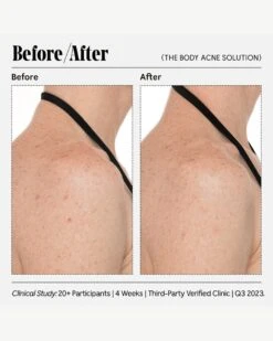 The Body Acne Solution -Beauty Essence Shop Necessaire RetailerGraphics 2023 TheBodyAcneSolution 07