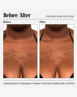 The Body Acne Solution -Beauty Essence Shop Necessaire RetailerGraphics 2023 TheBodyAcneSolution 09