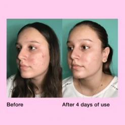 Pimple Paste Overnight Drying Paste -Beauty Essence Shop PIMPLEPASTE5