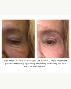 The Super Lift Vitamin C-More Treatment -Beauty Essence Shop SUPERLIFTCASESTUDY2