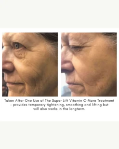 The Super Lift Vitamin C-More Treatment -Beauty Essence Shop SUPERLIFTCASESTUDY3