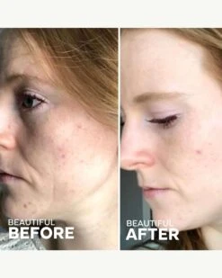 Refresh Papaya + Salicylic Acid Cleanser -Beauty Essence Shop ThreeShips RefreshCleanser BeforeAfter 04