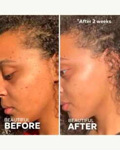 Superfruit Lactic + Multifruit 8% AHA Exfoliating Mask -Beauty Essence Shop ThreeShips SuperfruitExfoliatingMask BeforeAfter 05